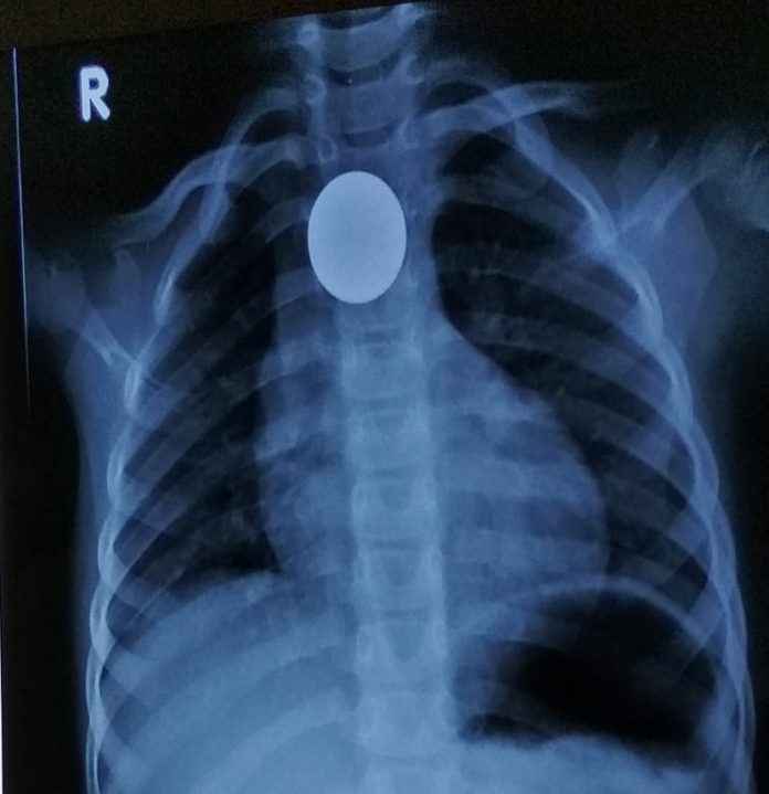 Three year girl swallowing 5 rupees coin: Doctors saved life