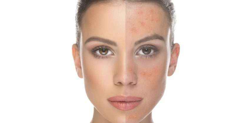 beauty face acne treatment
