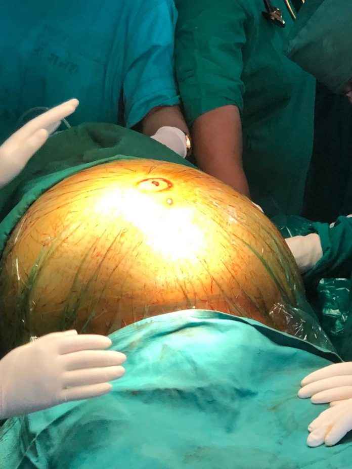 tumour of 30 kg from woman's body