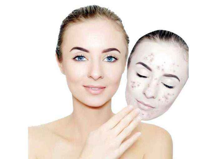 pimples treatment at home