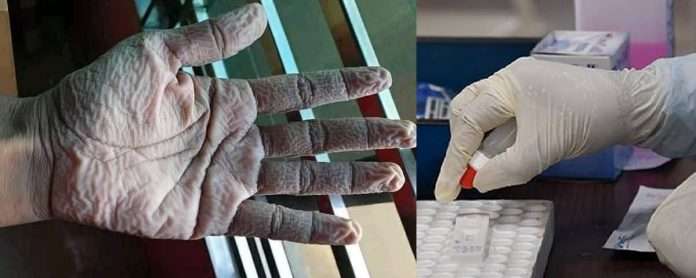 doctor hand after ppe kit use
