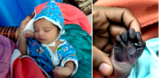 reaction after vaccination birth baby hand turned black poison vidisha bhopal