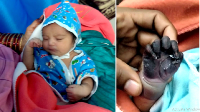 reaction after vaccination birth baby hand turned black poison vidisha bhopal