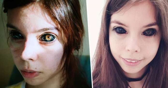 poland model ends up blind in one eye after botched eyeball tattoo procedure