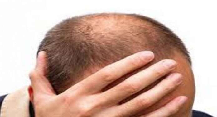 Husbands baldness exposed after marriage than wife filed a complaint