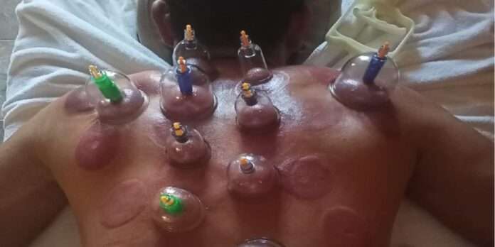 mohammed shami took cupping therapy