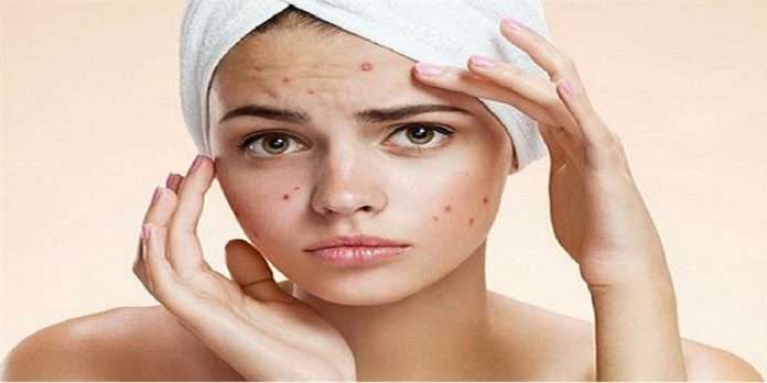 Does it cause pimples? Avoid eating these foods immediately