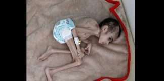 Yemeni boy, ravaged by hunger, weighs 7 kg