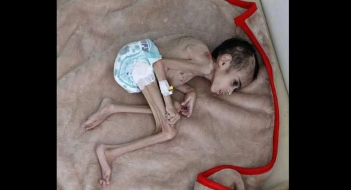 Yemeni boy, ravaged by hunger, weighs 7 kg