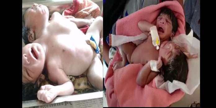 a woman give birth to conjoined twins having 3 arms and 2 heads in odisha