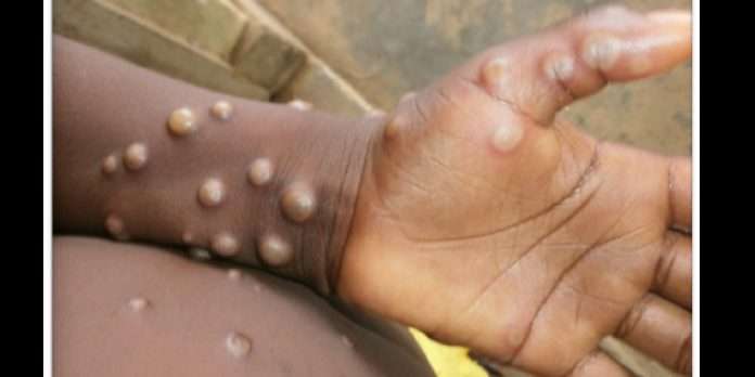 Two cases of monkeypox identified in north wales know what is monkeypox
