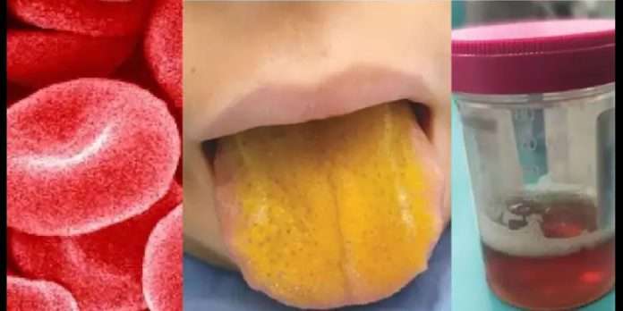 boy with bright yellow tongue diagnosed with rare autoimmune disorder
