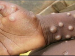 Monkeypox cases monkeypox europe case symptom vaccine who