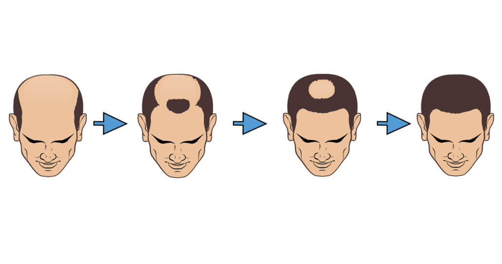 Does wearing a helmet cause hair loss?