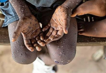 Health monkeypox risk increased worldwide; WHO has suggested five measures