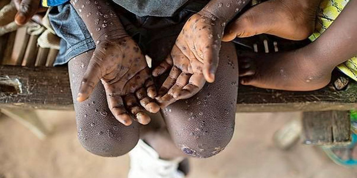 Health monkeypox risk increased worldwide; WHO has suggested five measures
