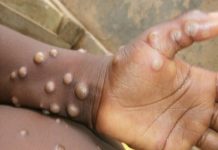 another suspected case of monkeypox reported in kerala
