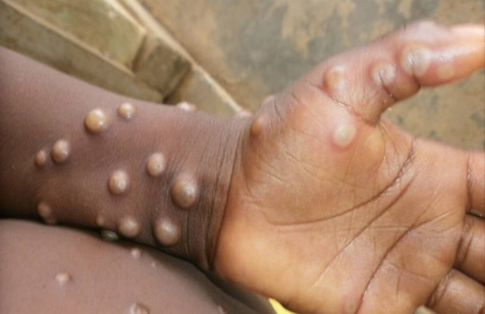 another suspected case of monkeypox reported in kerala