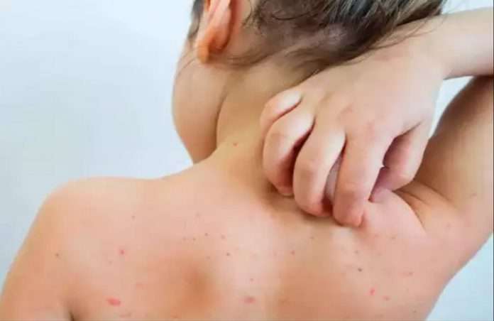 measles disease rubella or govar outbreak in mumba 412 children infected 21 children on oxygen