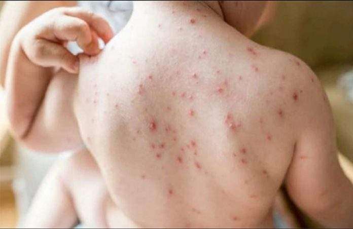 search for measles anitbodies now priority given to woman in nair hospital