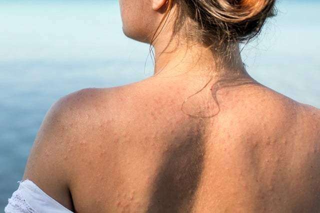 summer allergy : उन्हाळयात अ‍ॅलर्जीकडे करू नका दुर्लक्ष